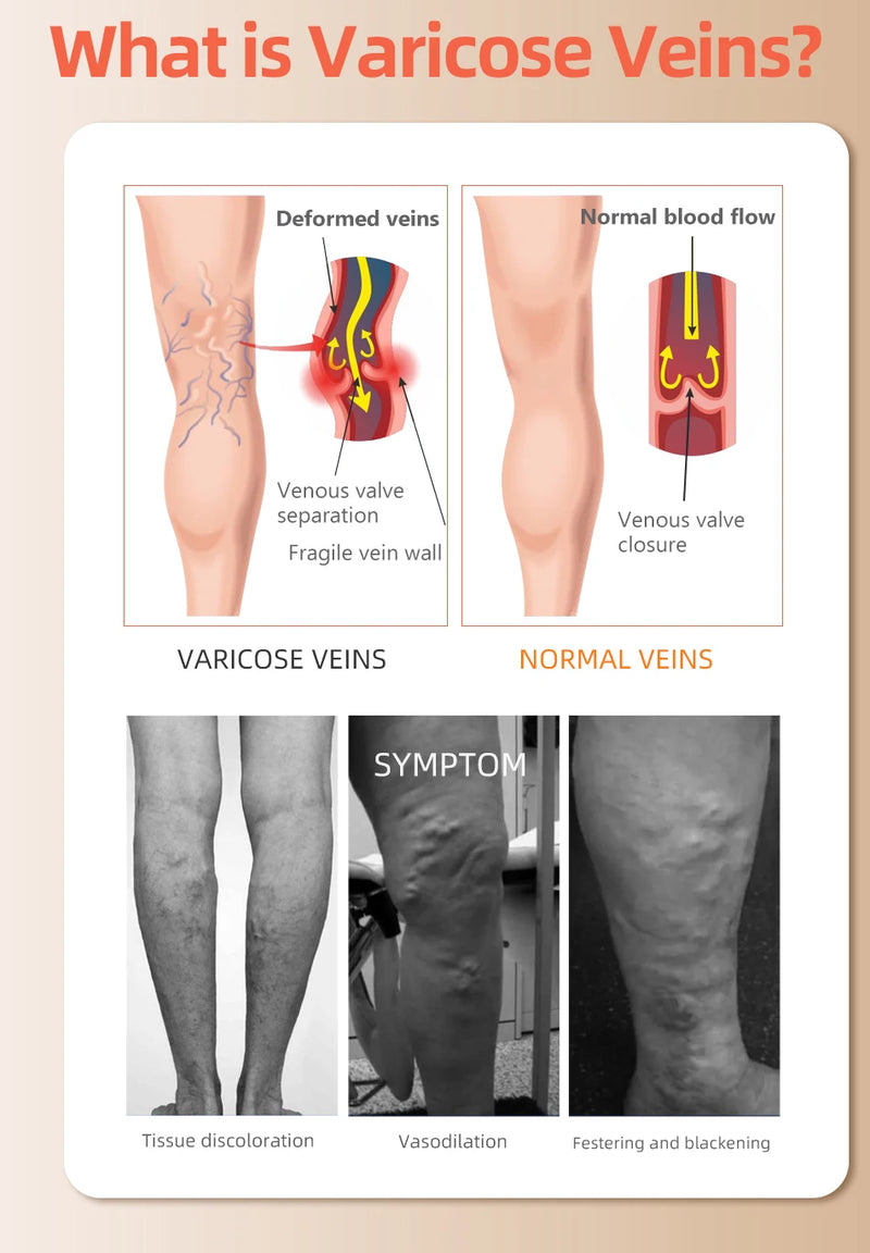 Medical Compression Stockings - Thigh High, Graduated Pressure, for Varicose Veins and Edema